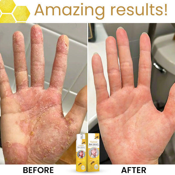 🏆✅FDA Endorsed🇺🇸 |🐝Vuitoze™ Bee Venom Eczema Treatment Spray