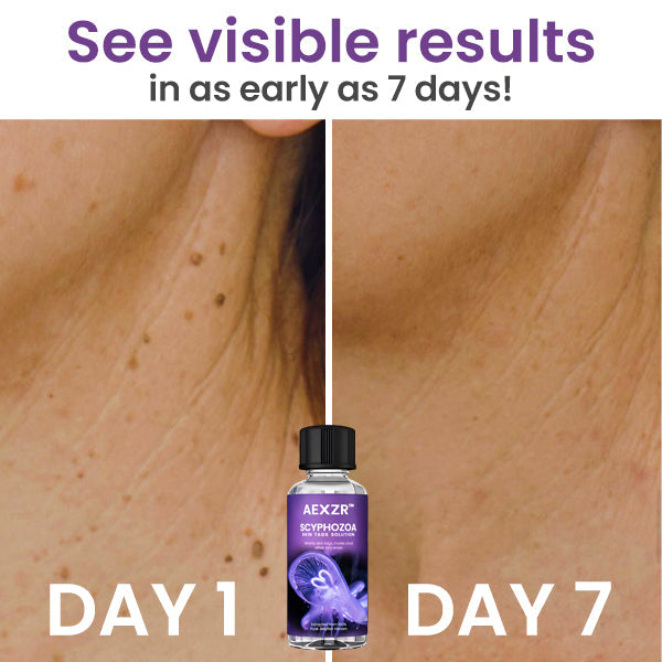 AEXZR™ Scyphozoa Skin Tags Solution