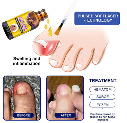 AEXZR™ Bee Venom Nail Fungus Treatment Solution