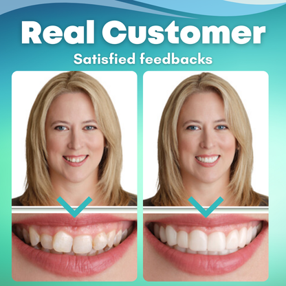 🔥2024 North America Best Seller TOP1🔥EzySmile™ SnapOn Silicone Veneers